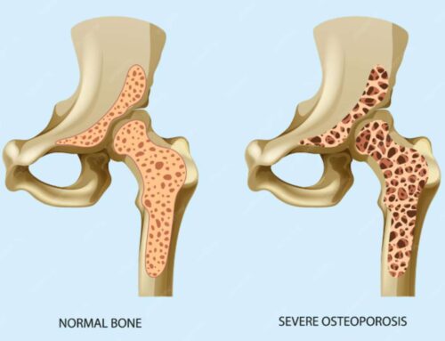 [울산 치과] 골다공증인데 임플란트, 정말 위험할까요? (안전한 치료를 위한 모든 것)