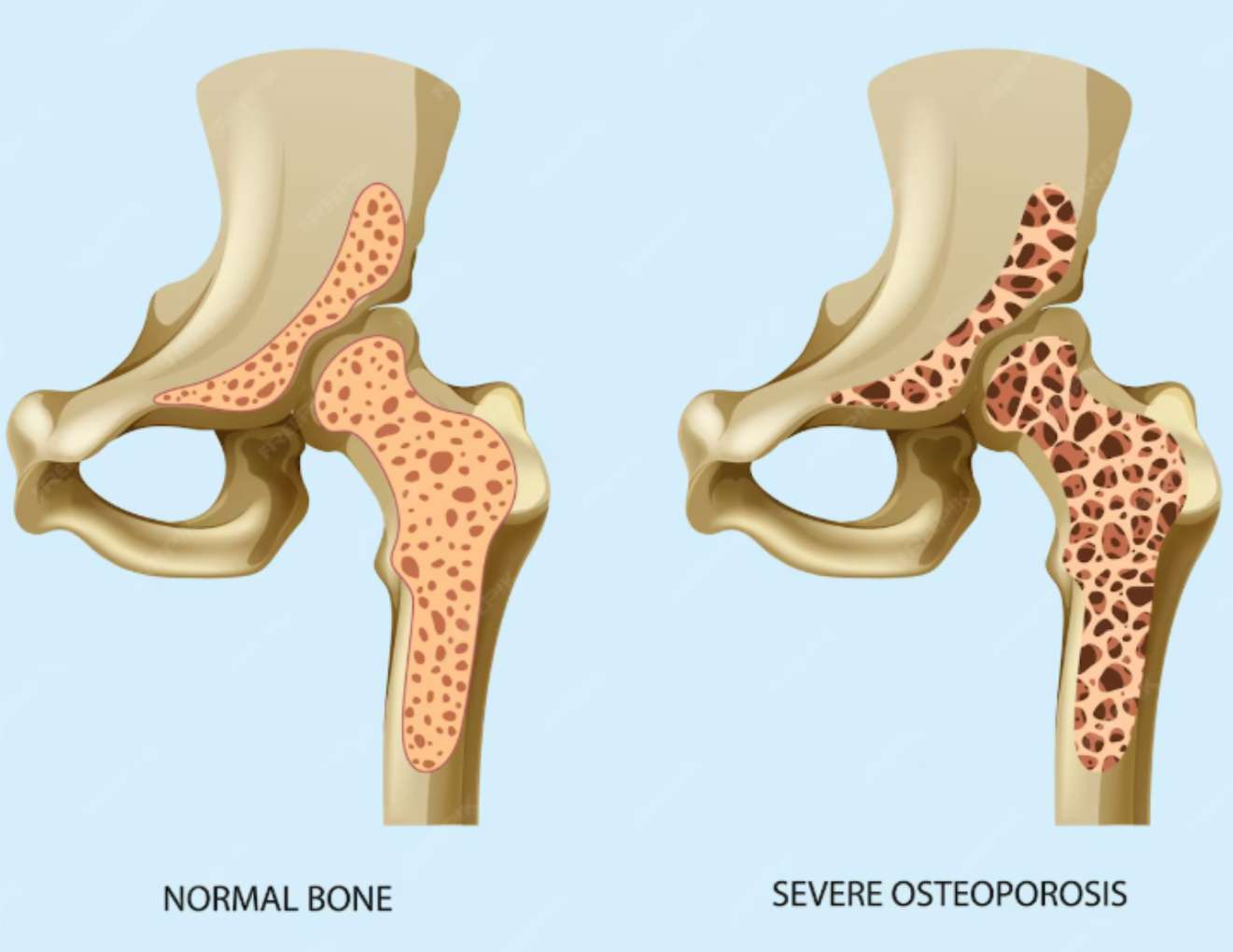 일반뼈와 골다공증 뼈를 비교한 이미지