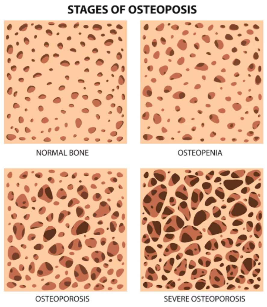 뼈 골 밀도의 차이 사진