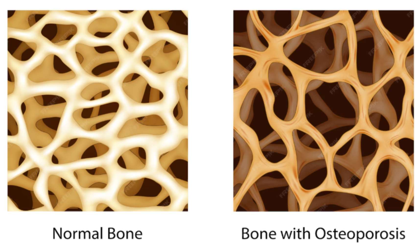 골다공증 뼈와 일반 뼈의 골밀도 차이