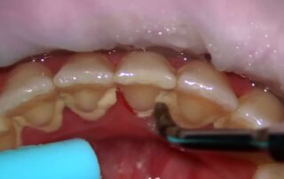 울산 드림연합치과에서 초음파 스케일러로 치아 뿌리 부분의 누런 치석을 정밀하게 제거하는 모습. 꼼꼼한 스케일링으로 잇몸 건강을 관리하고 법랑질 부식의 원인이 될 수 있는 세균 서식지를 제거.