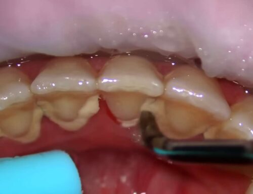 ‘스케일링’이란? 주의사항, 관리법 A to Z (울산 드림연합치과)