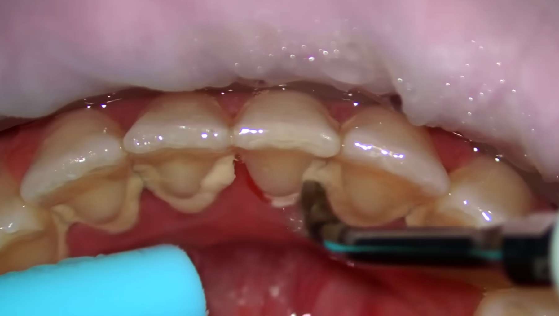 울산 드림연합치과에서 초음파 스케일러로 치아 뿌리 부분의 누런 치석을 정밀하게 제거하는 모습. 꼼꼼한 스케일링으로 잇몸 건강을 관리하고 법랑질 부식의 원인이 될 수 있는 세균 서식지를 제거.