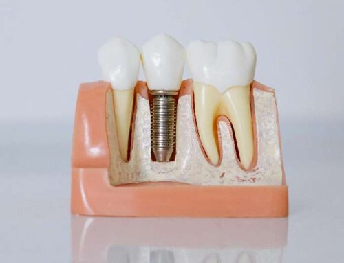 울산 임플란트 과정 | 최신 디지털 방식, 기간, 재료 총정리 (드림연합치과)