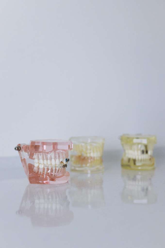 오래된 보철물로 인한 치아 이물감의 원인을 설명하기 위한 다양한 치과 치료 모형들.