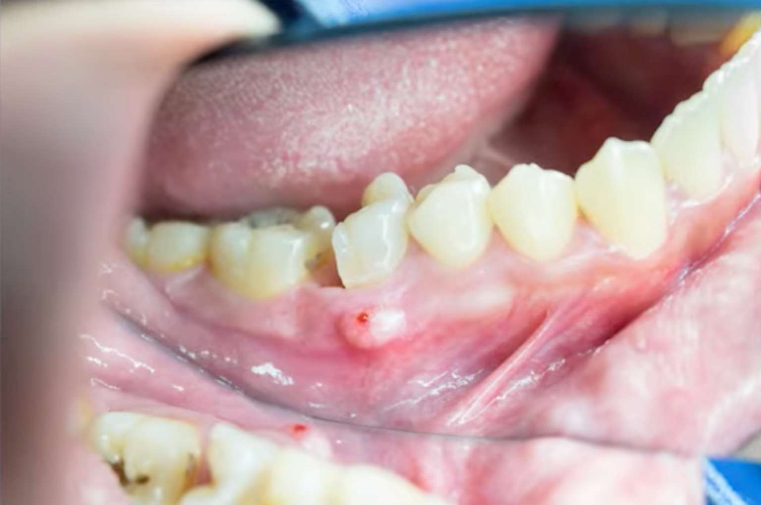 고름주머니2 아래 잇몸에 생긴 고름 주머니와 중앙의 붉은 배출구(누공) 흔적