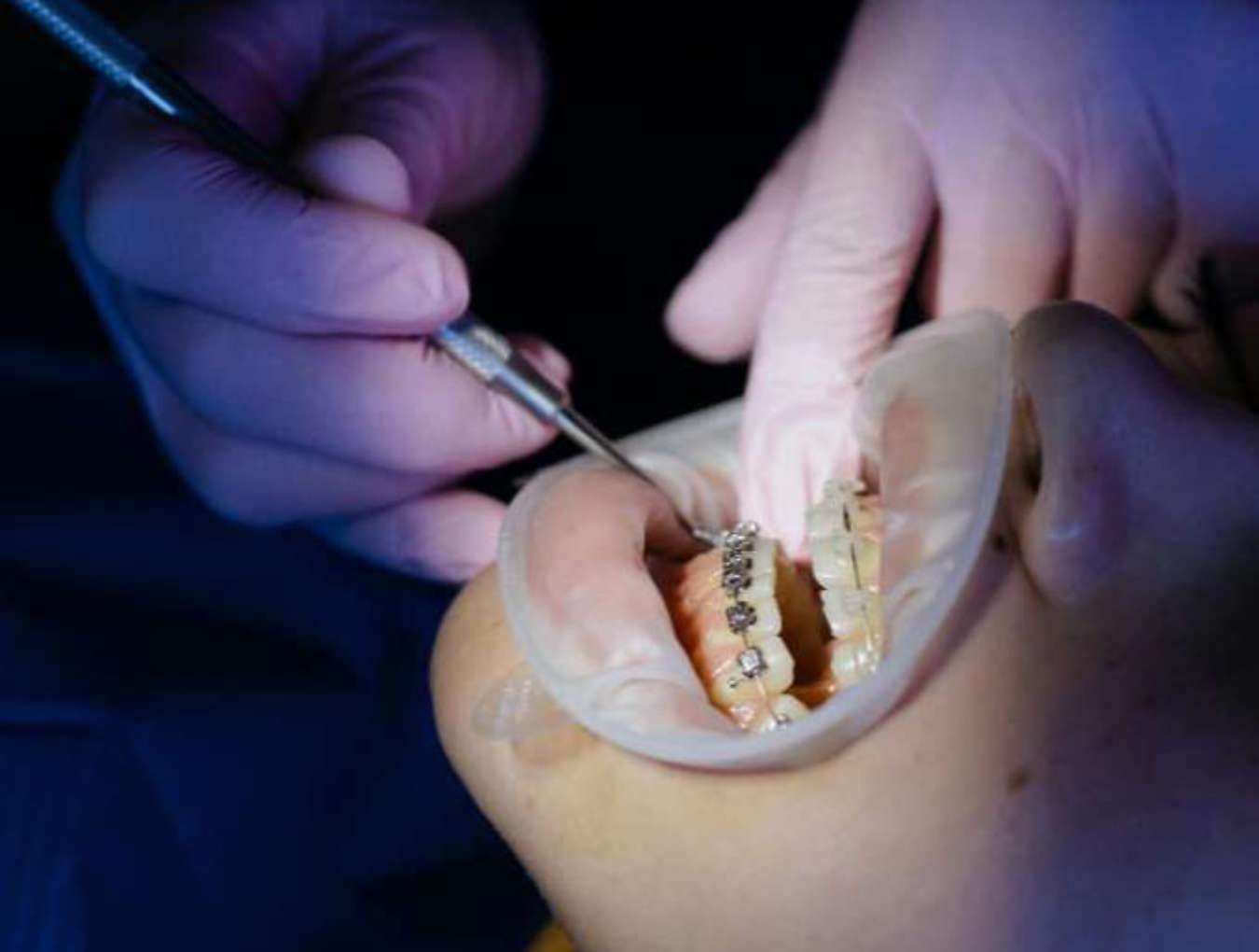 교정 장치 부착 상태와 치아 이동 현황을 꼼꼼하게 점검하는 울산 교정 치과 진료