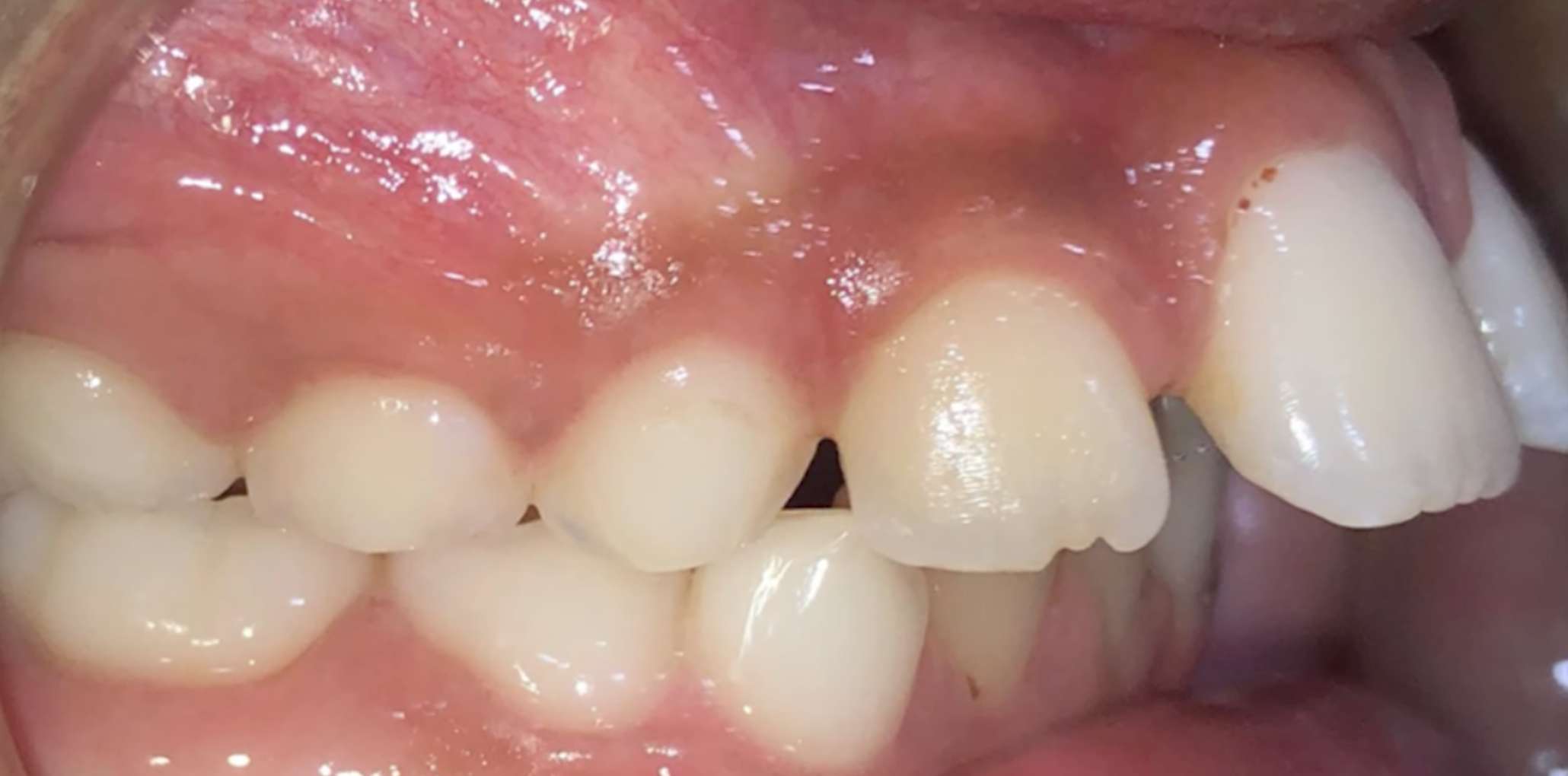 손가락 빨기 부작용으로 앞니가 다물어지지 않는 개방교합 증상