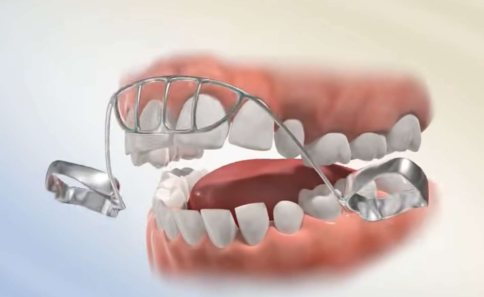 손가락 빨기를 물리적으로 막아주는 구강 내 습관 차단 장치