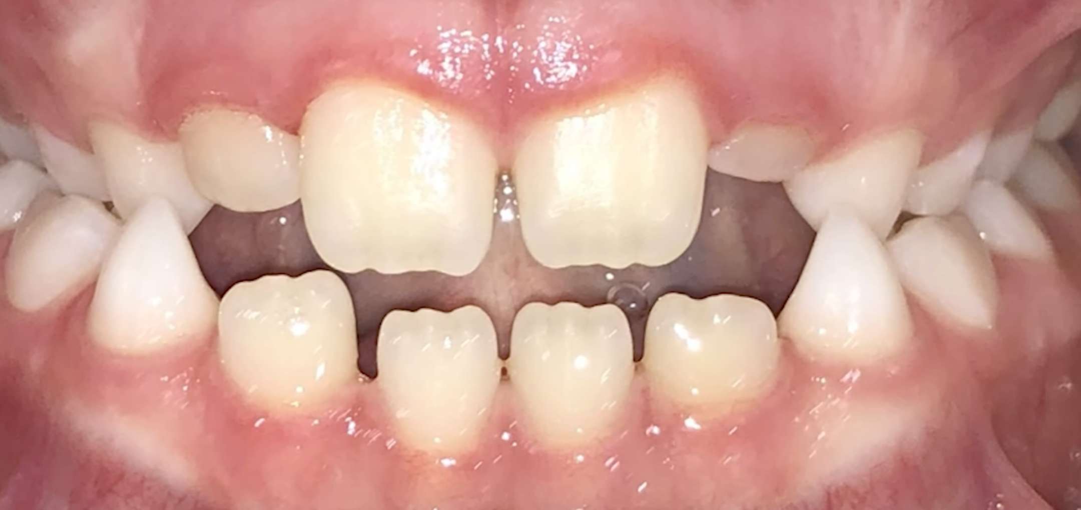 손가락 빨기 부작용으로 앞니가 다물어지지 않는 개방교합 증상