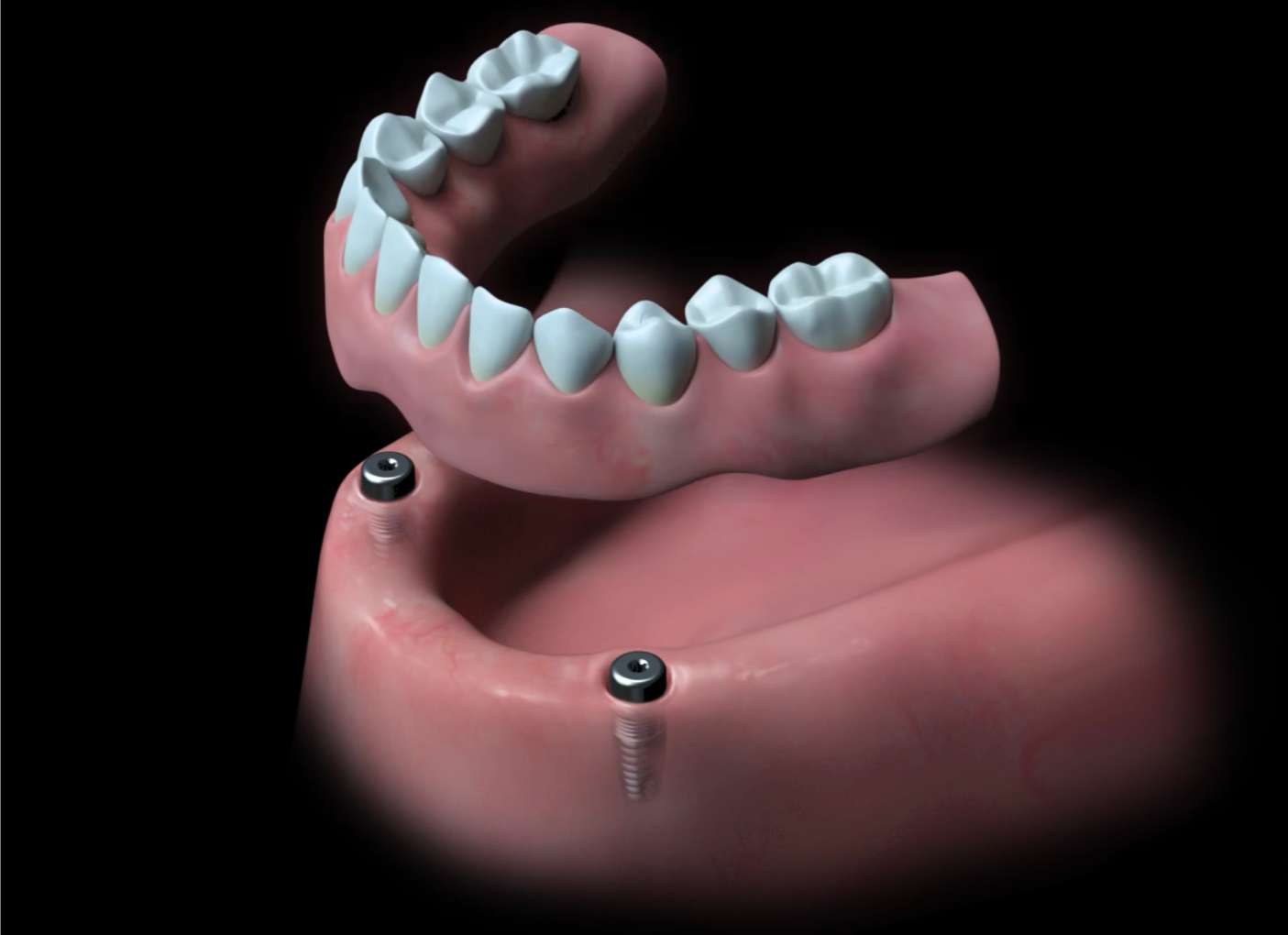 임플란트와 틀니1 소수의 임플란트에 틀니를 단추처럼 고정하는 임플란트 틀니(오버덴쳐) 원리