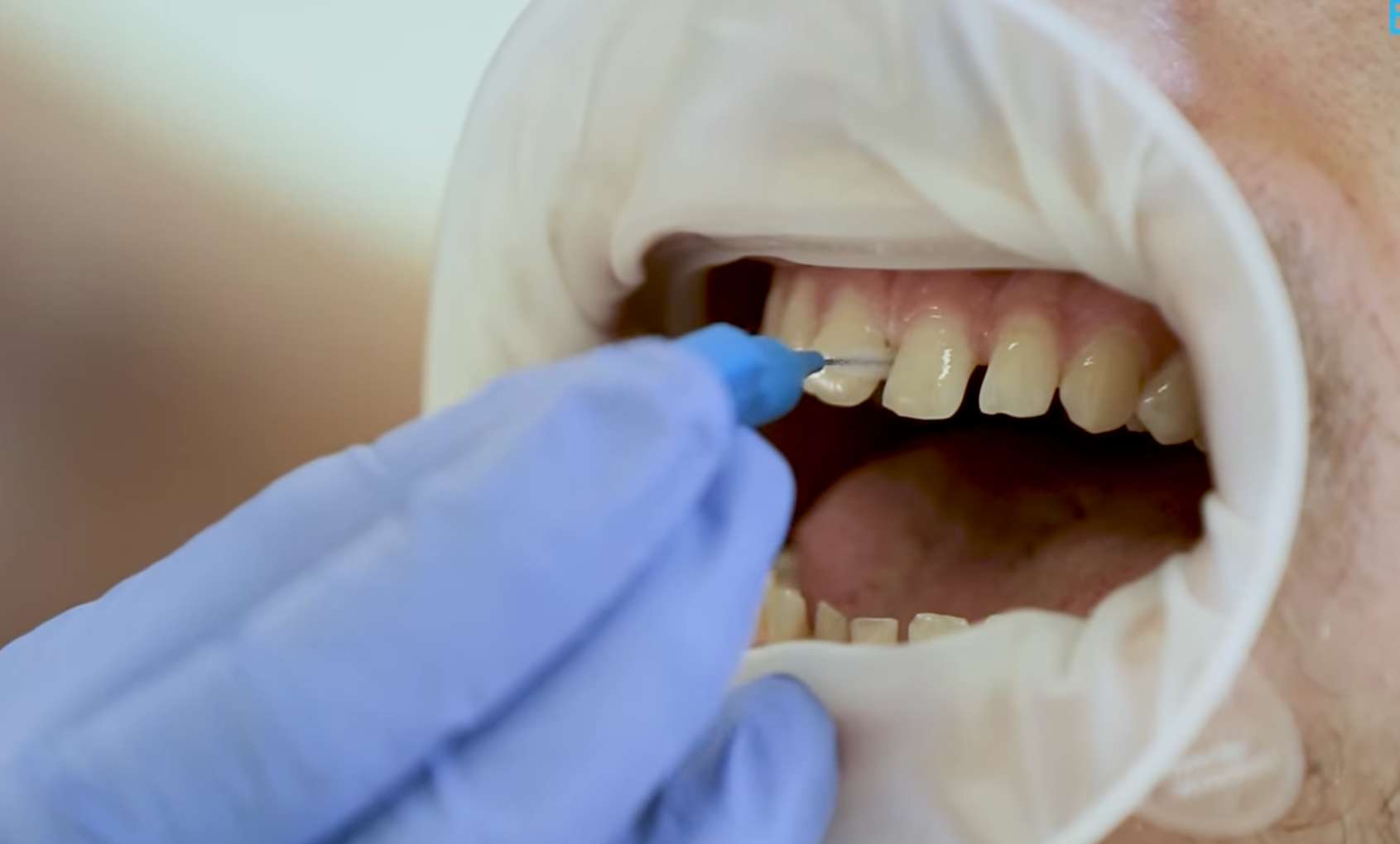 치간칫솔10 치아 모형을 이용한 치간칫솔 사용법 시연, 어금니 틈새 관리, 올바른 치간칫솔 각도