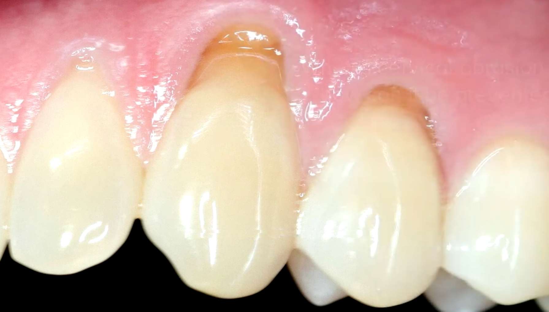 치아 목 부분이 도끼로 찍은 듯 패여 나가는 치경부 마모증 증상 사진