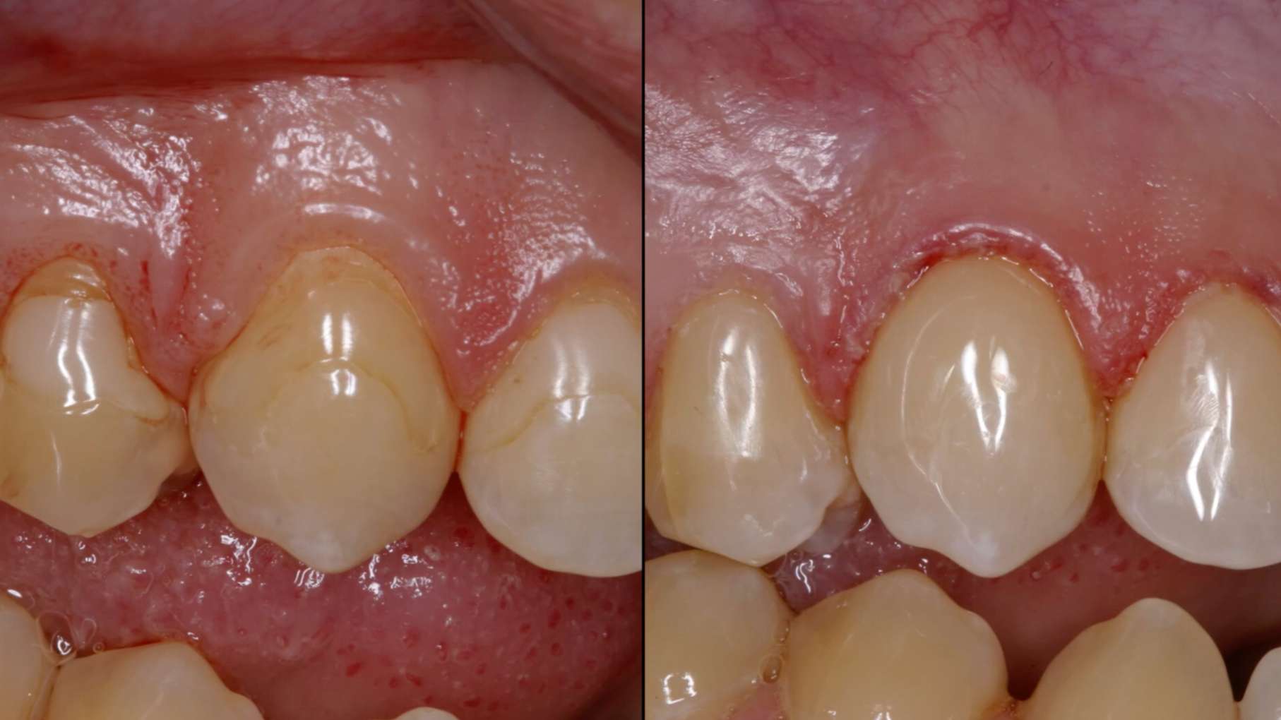 패인 치아 부위를 레진으로 메워 시린 증상을 없애는 치료 과정