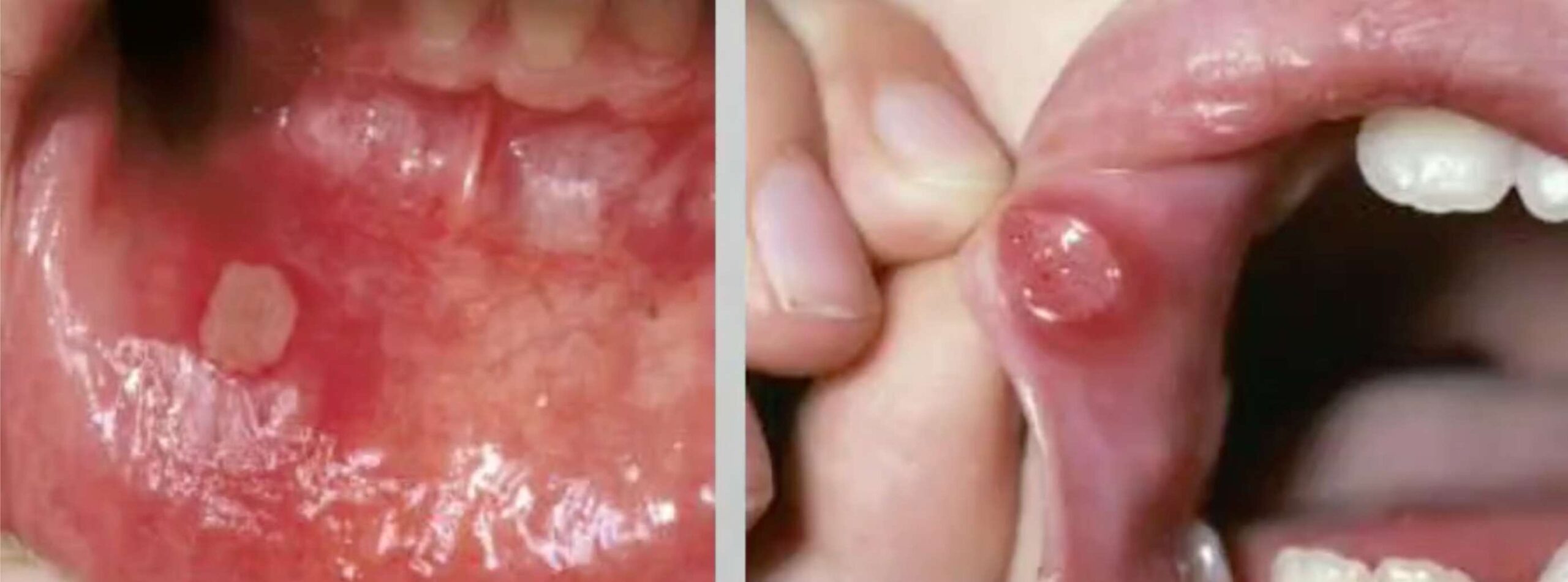 구내염2 입술 안쪽에 생긴 하얗고 둥근 아프타성 구내염 확대 사진