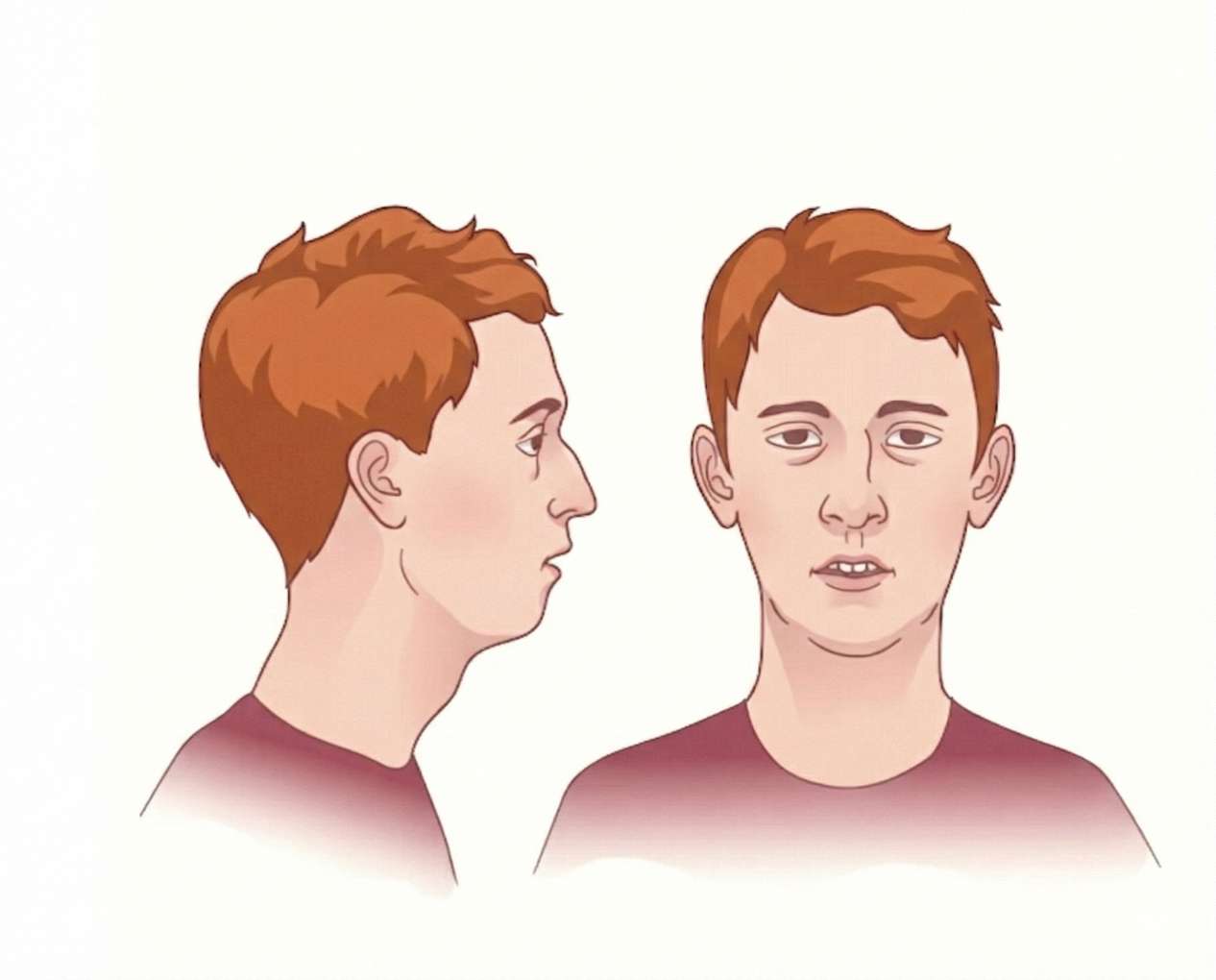 입으로 숨 쉬는 습관이 만드는 아데노이드형 얼굴 변형 과정 설명