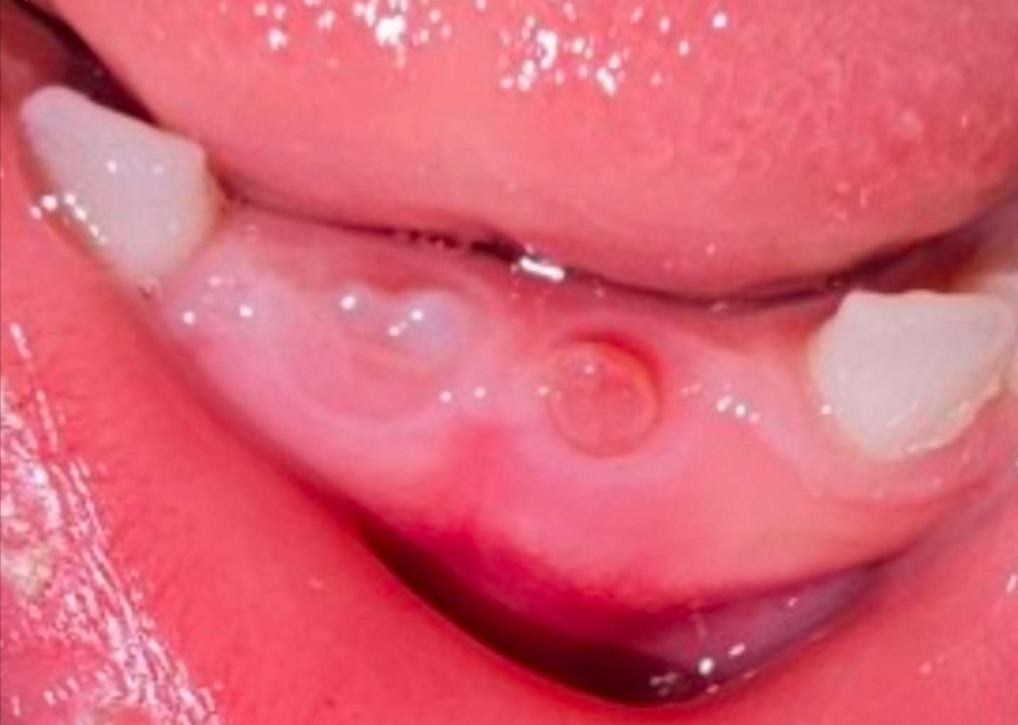 유치 발치 후 잇몸에 남은 붉은색 육아조직(새 살) 확대 사진