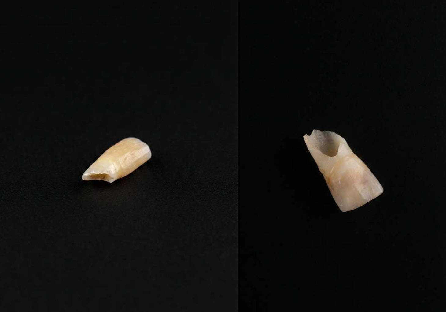 영구치 맹출로 인해 뿌리가 흡수되고 머리만 남은 유치 껍데기