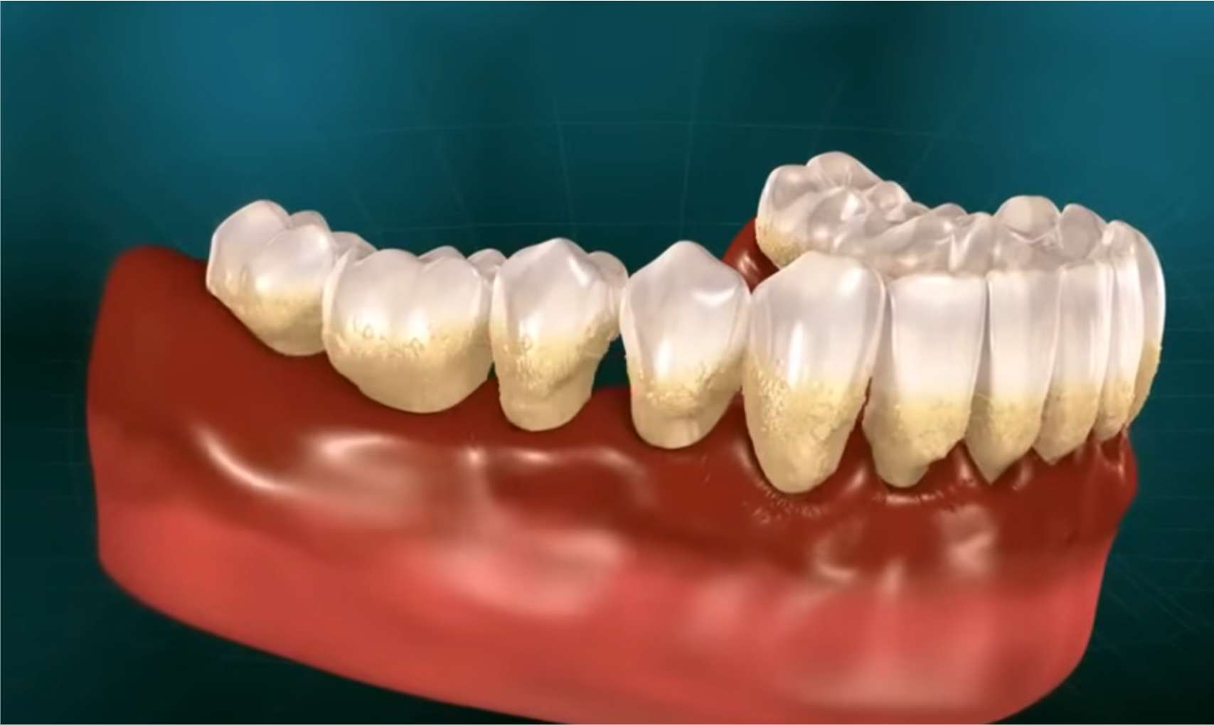 풍치1 치주염(풍치)으로 인해 잇몸이 내려앉고 결국 치아가 빠지는 과정을 보여주는 3D 그래픽