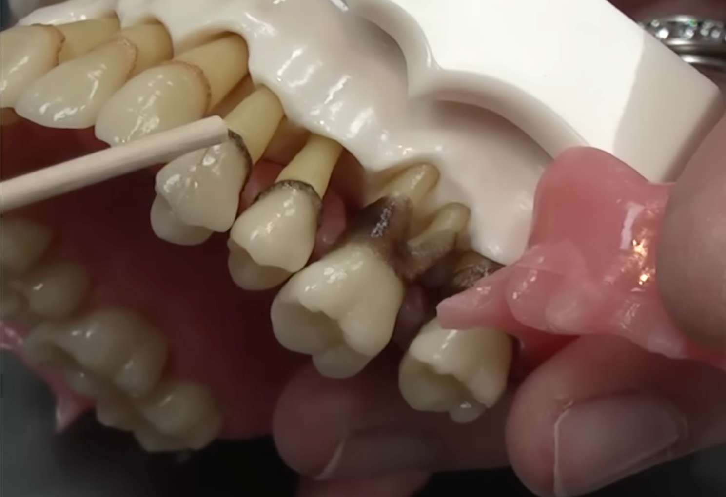 풍치5 치아 모형을 통해 뿌리 깊이 파고든 검은 치석과 잇몸 퇴축의 심각성을 설명하는 모습