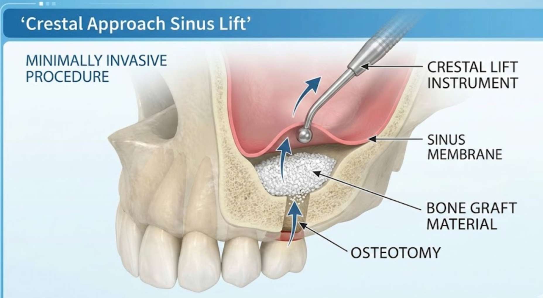 잇몸 구멍을 통해 아래에서 위로 막을 들어 올리는 치조정 접근법 일러스트