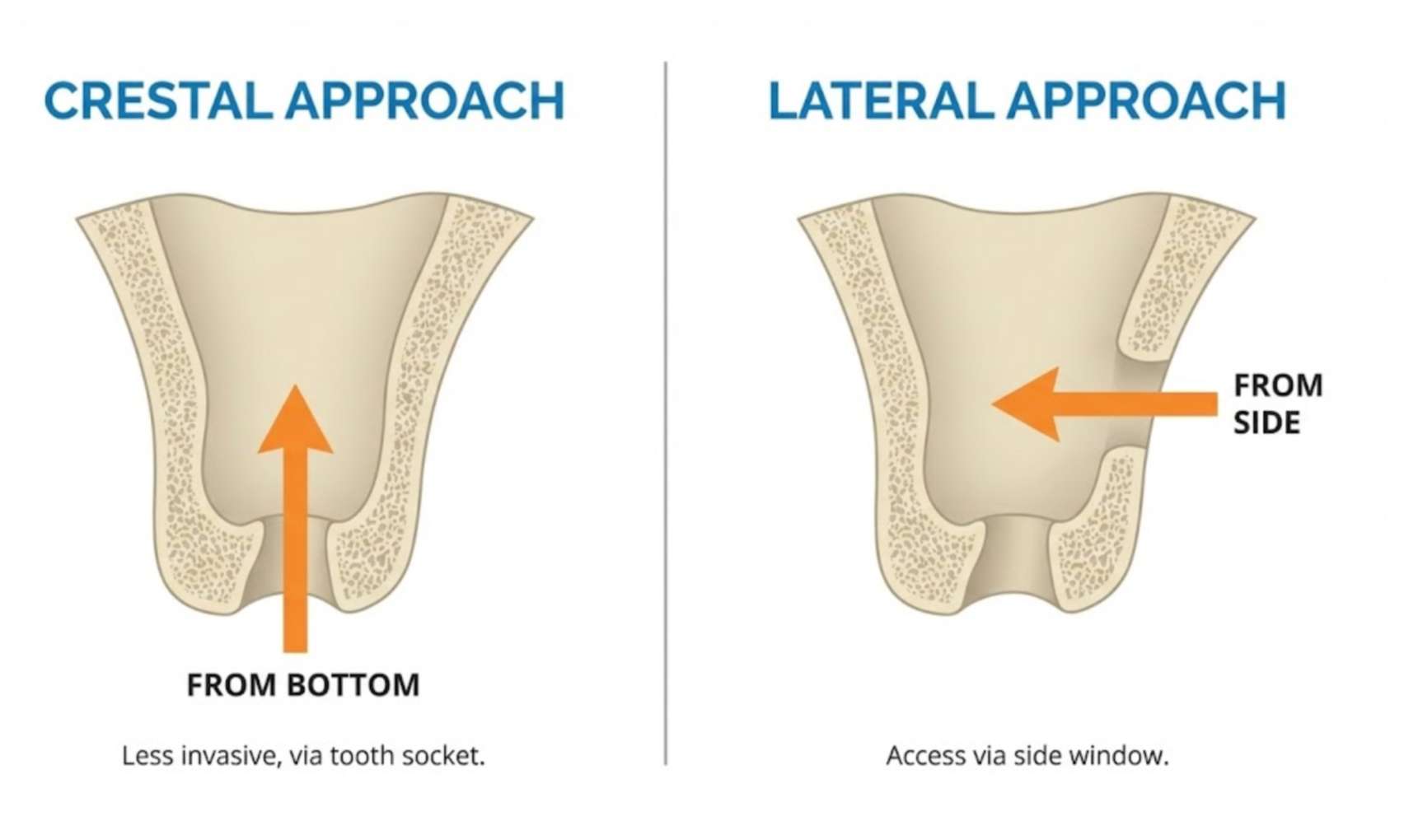 상악동 거상술의 두 가지 방법인 치조정 접근법과 측방 접근법 비교 인포그래픽