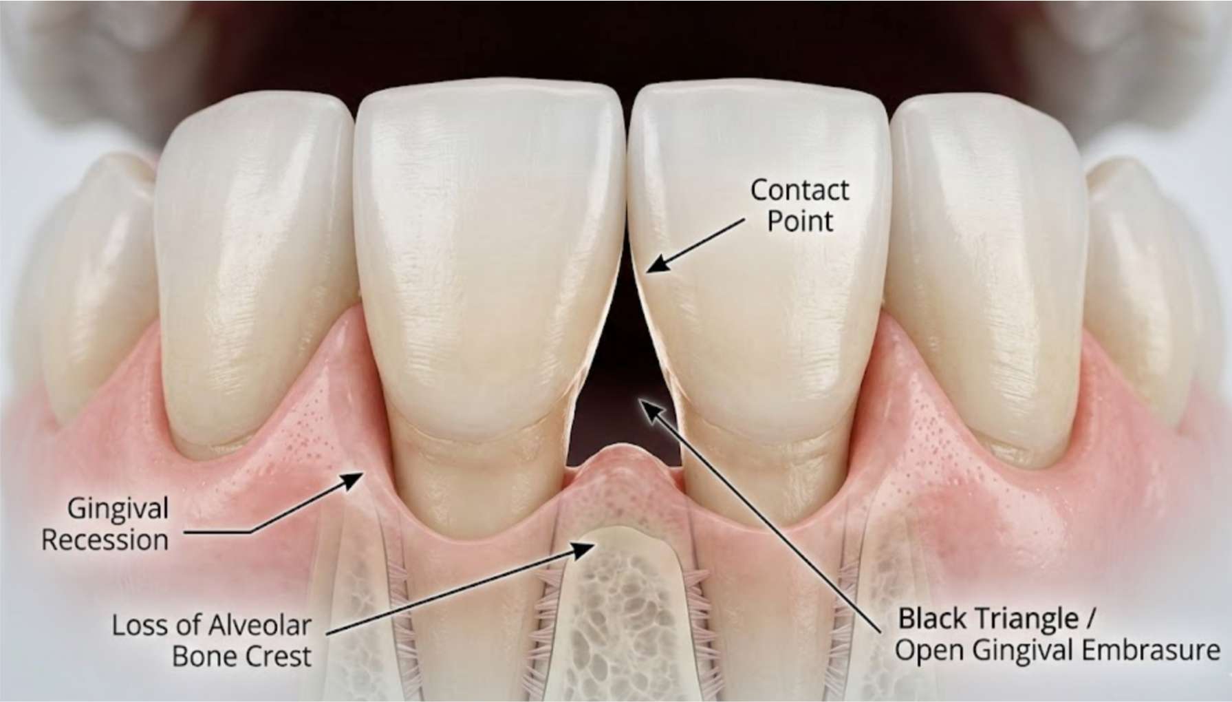 앞니부분교정5 교정 후 잇몸 사이에 발생할 수 있는 블랙 트라이앵글 일러스트
