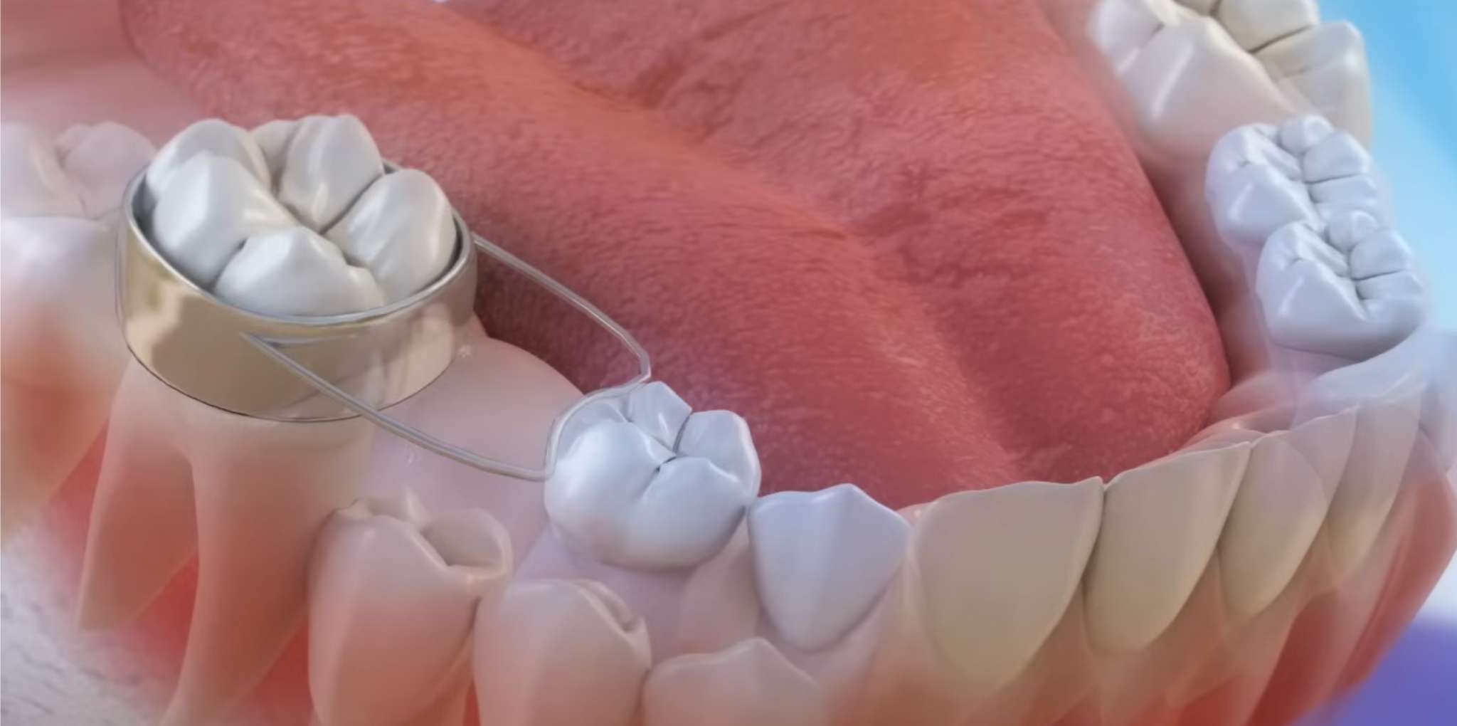 유치관리3 영구치 맹출 공간을 확보해 주는 밴드 앤 루프(Band & Loop) 공간 유지 장치