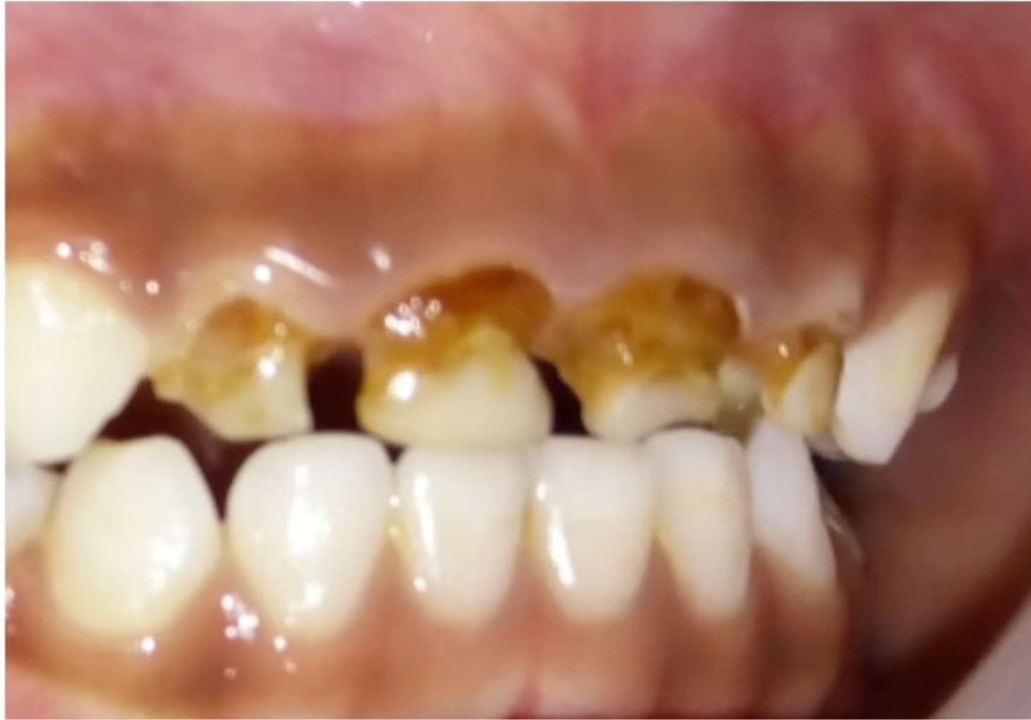 유치관리9 유아 앞니 충치, 우유병 우식증 진행 단계, 삭은 유치, 소아치과 치료가 필요한 치아 부식 상태.