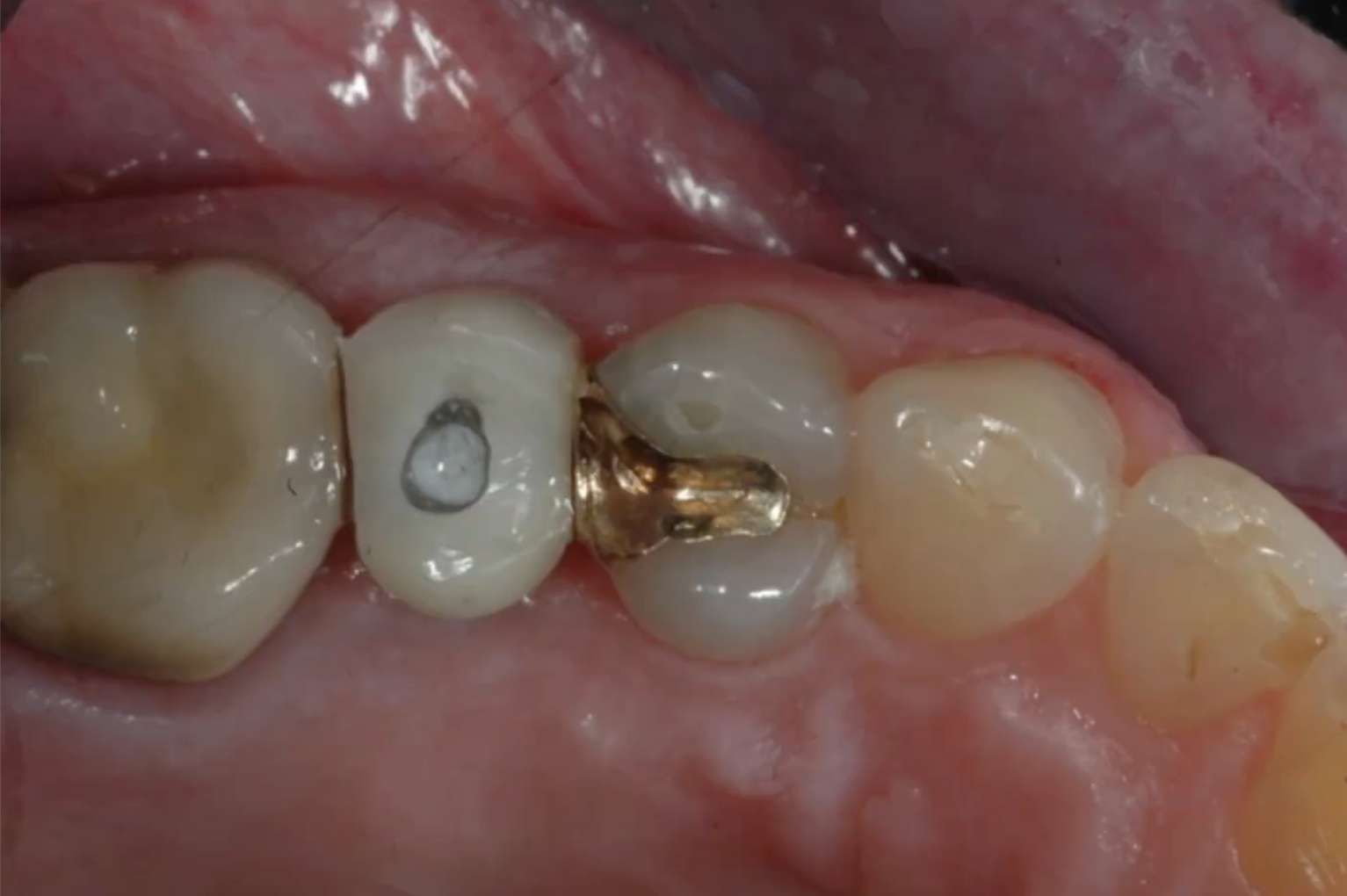 임플란트 내부 나사를 조이고 풀기 위해 존재하는 나사 구멍(Access Hole) 구조도