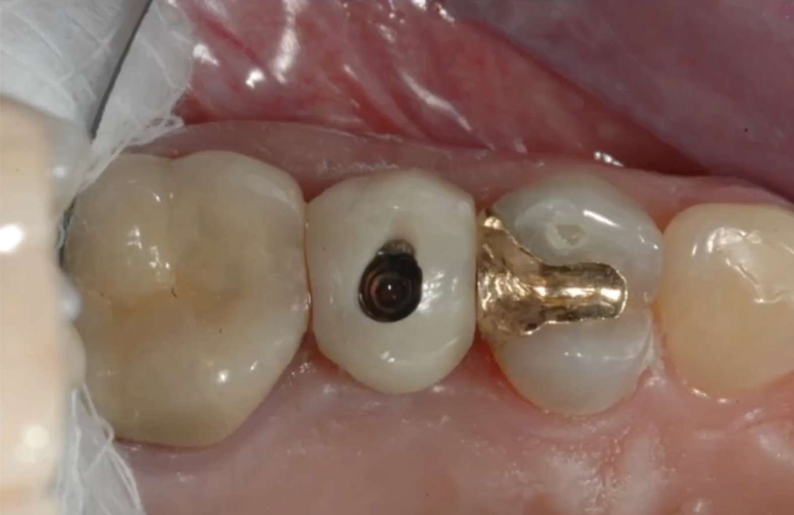 껌이나 엿 같은 끈적한 음식에 의해 임플란트 구멍을 메운 레진이 빠지는 모습