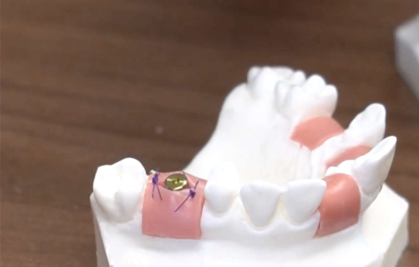 임플란트 수술 후 잇몸을 검은색 실크 봉합사로 꿰매 놓은 상태 확대 사진