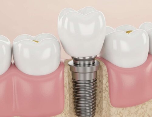 [울산 임플란트] 실밥이 풀리거나 먹었어요! 수술 잘못된 걸까요? (제거 통증/덜렁거림 대처법)