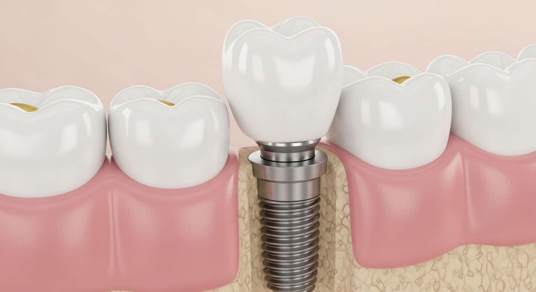 [울산 임플란트] 실밥이 풀리거나 먹었어요! 수술 잘못된 걸까요? (제거 통증/덜렁거림 대처법)