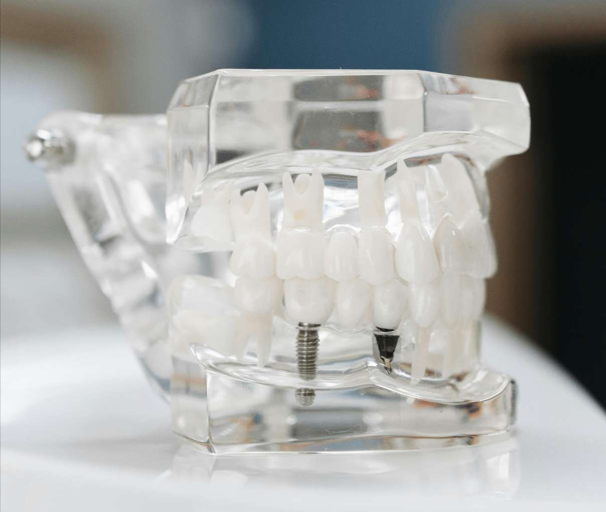 임플란트 악취12 투명한 치아 모형을 통해 보이는 임플란트 나사(픽스처)와 지대주 연결 구조