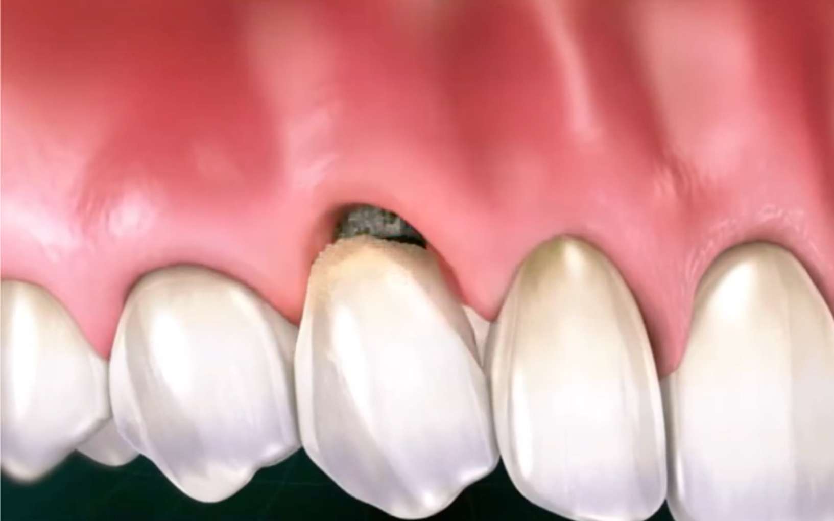 임플란트 악취3 잇몸이 붉게 붓고 염증이 생긴 임플란트 주위염 증상 시각화