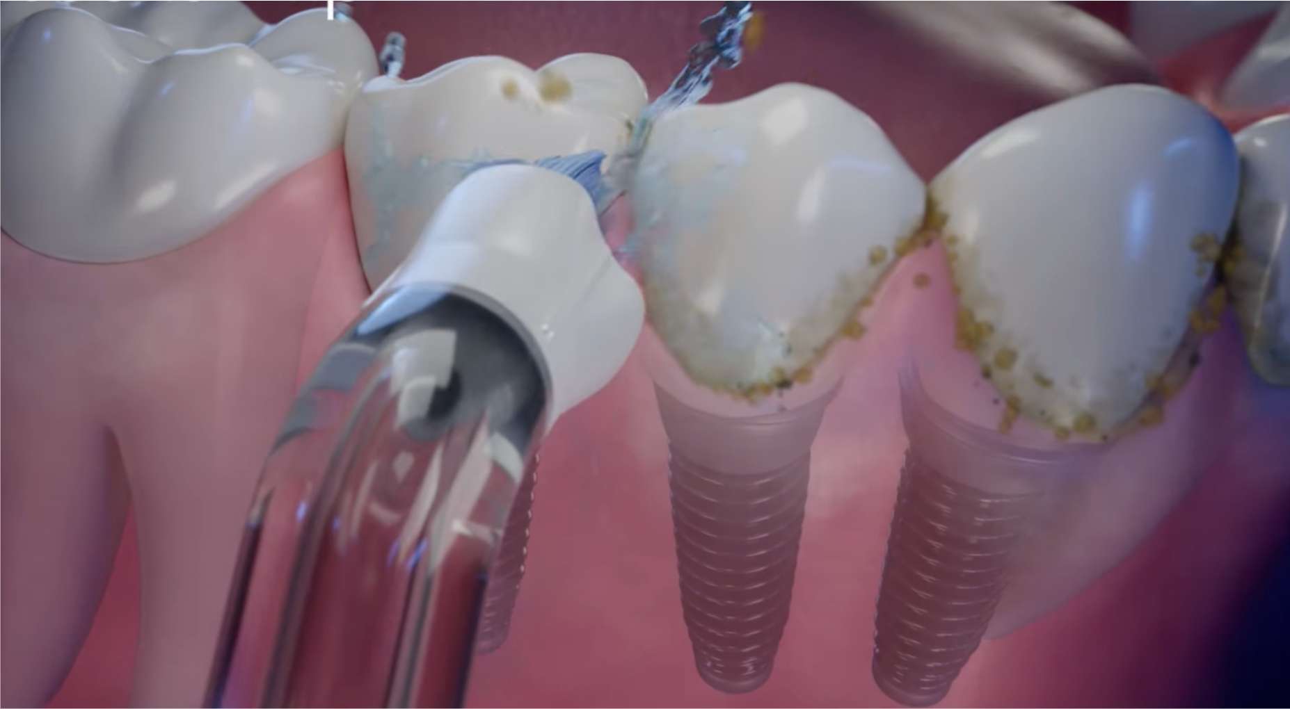 임플란트 악취5 임플란트 주변 음식물 찌꺼기를 제거하는 올바른 워터픽 사용법