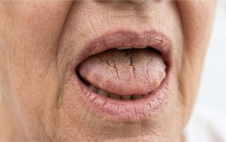 입을 벌렸을 때 혀 표면이 심하게 갈라지고 건조해진 상태를 촬영한 실제 임상 근접 사진.