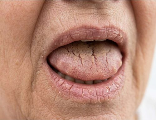 [울산 치과] 50대 이후 입마름? 구강건조증 방치하면 잇몸 무너집니다