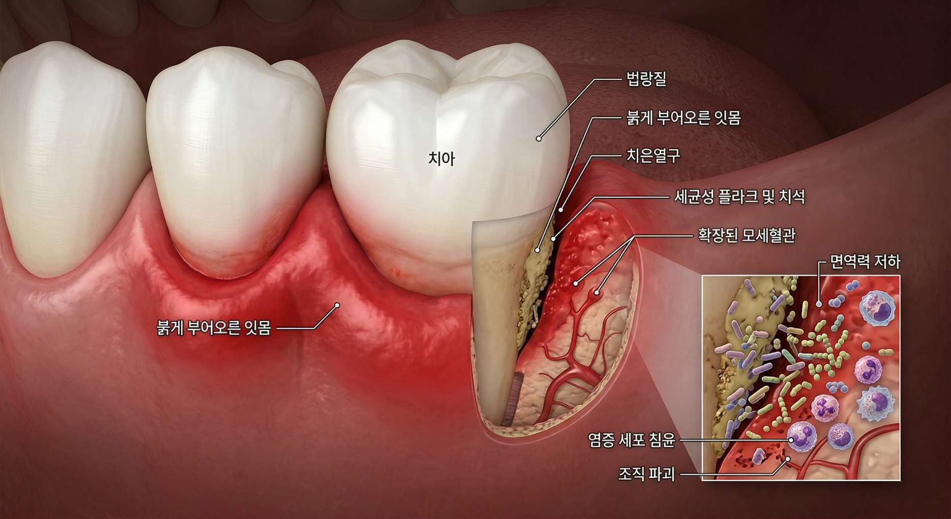 면역력 저하성 치은염1 치아와 잇몸의 구조 및 치은염 진행 과정을 보여주는 3D 의학 일러스트. 붉게 부어오른 잇몸과 치아 사이(치은열구)에 쌓인 세균성 플라크 및 치석이 단면으로 묘사되어 있다. 우측 하단의 확대된 화면에서는 면역력 저하로 인해 염증 세포가 침윤하고 조직이 파괴되며, 확장된 모세혈관 주변으로 세균이 번식하는 모습이 상세히 설명되어 있다.
