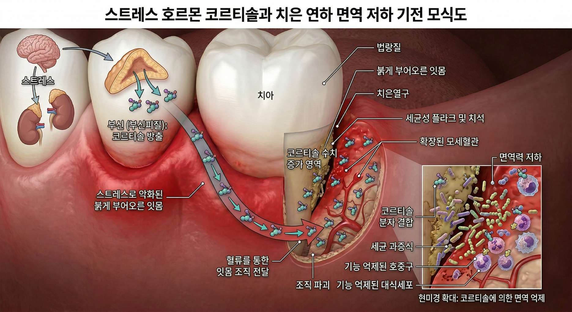 면역력 저하성 치은염2