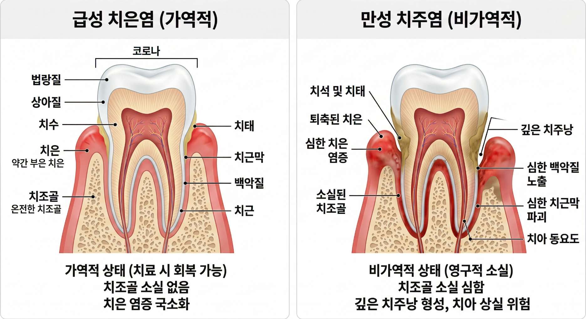 면역력저하성 치은염11 급성 치은염(가역적)과 만성 치주염(비가역적)을 비교하는 의학 일러스트. 왼쪽은 잇몸만 살짝 붓고 치조골(잇몸뼈)은 온전한 치은염 상태를, 오른쪽은 치석으로 인해 잇몸이 퇴축되고 치조골이 소실되어 치아가 흔들리는 심각한 치주염 상태를 대조하여 각 부위의 명칭과 함께 상세히 설명하고 있다.