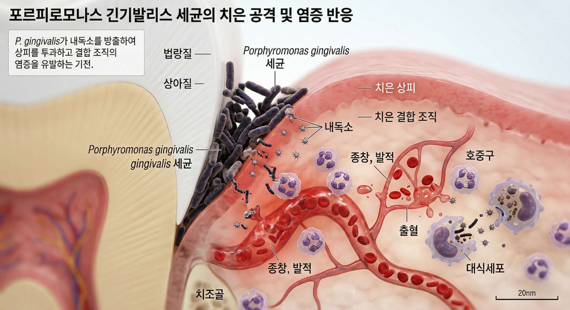 면역력저하성 치은염3 포르피로모나스 긴기발리스 세균이 치아와 잇몸 사이에서 내독소를 방출하며 침투하는 모습을 담은 의학 일러스트. 잇몸 상피와 결합 조직 내에서 종창, 발적, 출혈이 일어나는 과정과 이에 대응하는 호중구, 대식세포 등 면역 세포들의 활동이 상세한 한글 라벨과 함께 묘사되어 있다.