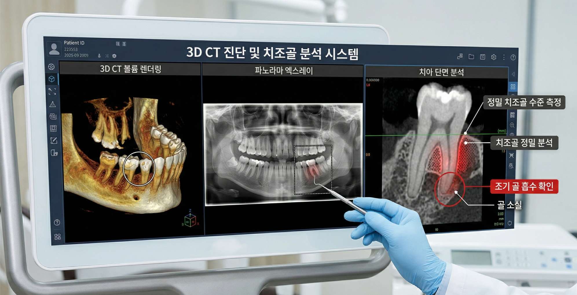 면역력저하성 치은염8 3D CT 볼륨 렌더링, 파노라마 엑스레이, 치아 단면 분석 등 세 가지 진단 영상이 통합된 치과용 모니터 화면. 파노라마 영상에서 어금니 부위의 잇몸 뼈(치조골) 소실이 확인되어 별도로 표시되어 있습니다. 파란색 장갑을 낀 치과의사의 손이 도구로 '골 소실' 부위를 가리키고 있습니다. '3D CT 진단 및 치조골 분석 시스템', '정밀 치조골 수준 측정', '치조골 정밀 분석', '조기 골 흡수 확인' 등의 한글 안내 텍스트가 포함되어 있습니다.