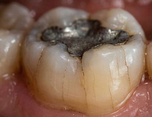 [울산 치과] 아말감 하방의 2차 충치, ‘교체 시기’를 결정하는 핵심 포인트