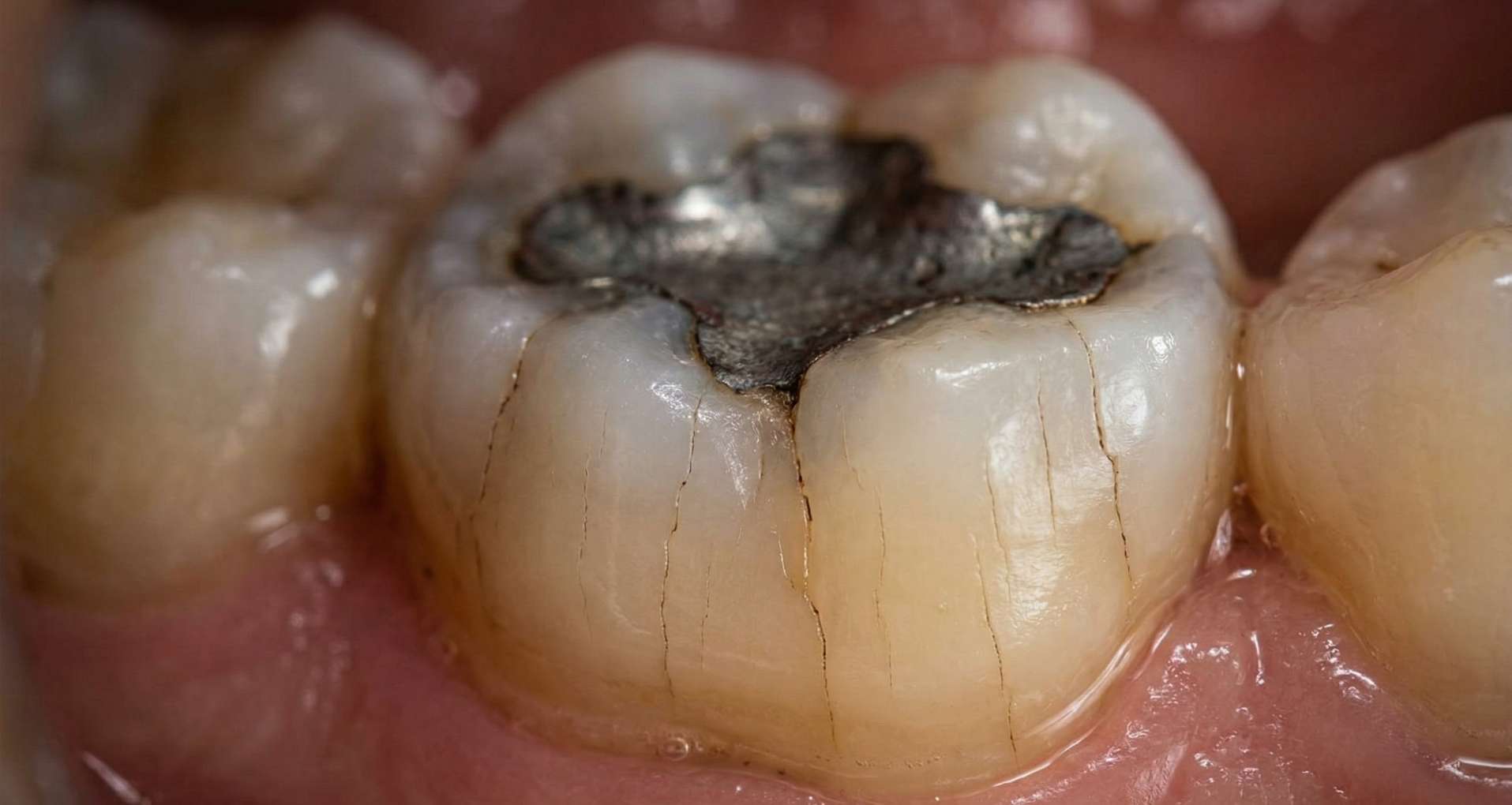 아말감의 팽창으로 인해 주변 치아 벽에 미세한 금이 간 상태