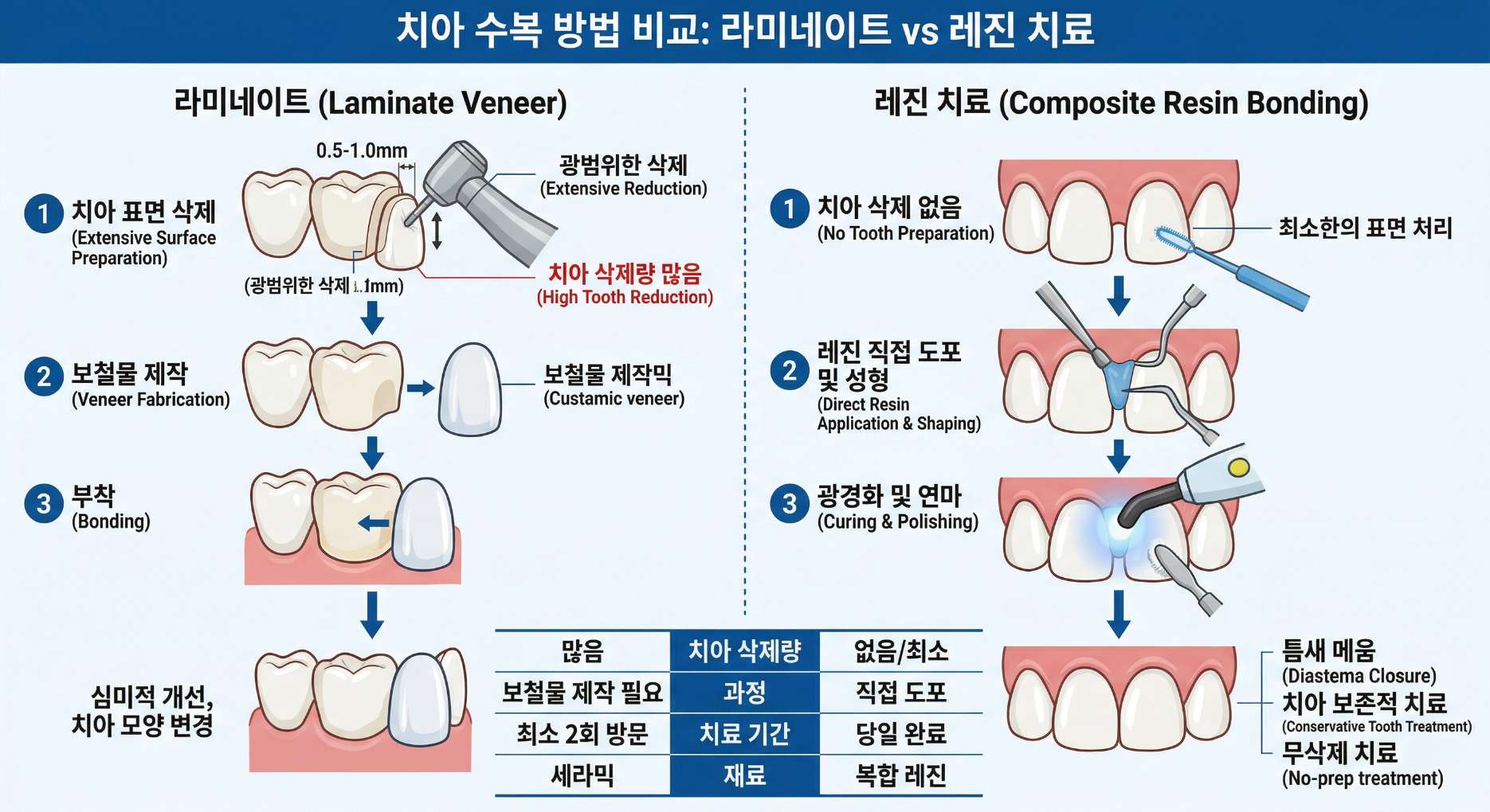 치아 표면을 깎아내는 라미네이트와 치아 삭제 없이 진행되는 레진 치료의 차이점 및 과정을 비교한 인포그래픽