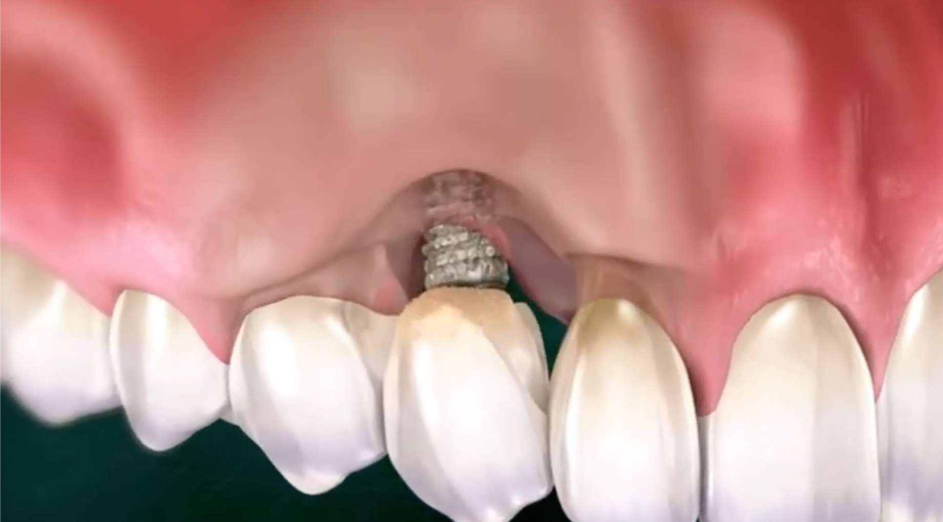 상악 잇몸뼈가 흡수되어 임플란트 나사선이 노출되고 주위염이 진행된 상태를 보여주는 3D 치과 일러스트.
