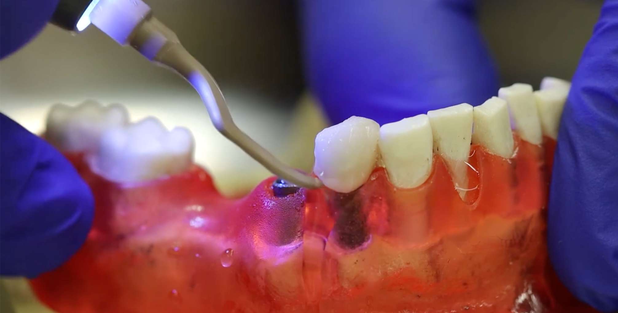 파란색 장갑을 낀 의료진이 턱 모형에 심어진 임플란트 주변을 특수 스케일러 도구로 세밀하게 닦아내는 모습.