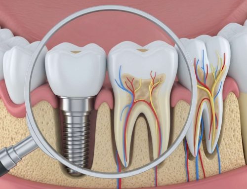 [울산 치과] 임플란트 수명 2배 늘리는 관리법 | 울산 임플란트 관리 정기검진